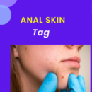 anal skin tag