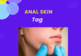 anal skin tag