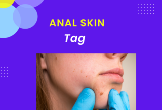 anal skin tag