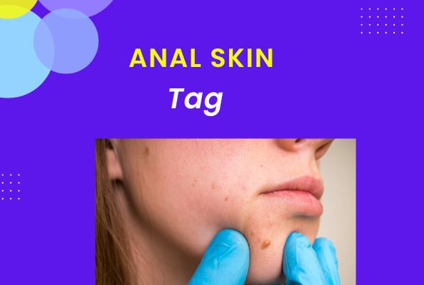 anal skin tag