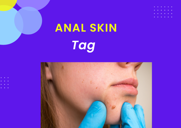 anal skin tag